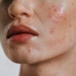 Kulit Jerawat Bebas Mulus? 4 Sabun Muka Rp30 Ribuan Aja!